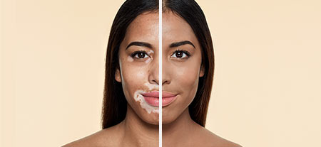 v_before_after-vitiligo.jpg