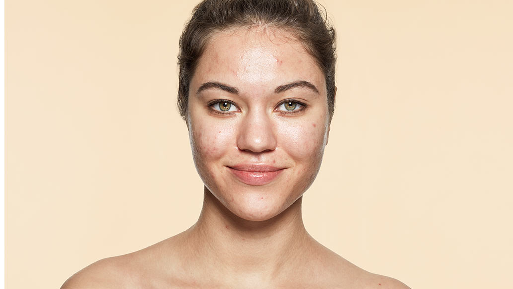 v_before-acne.jpg