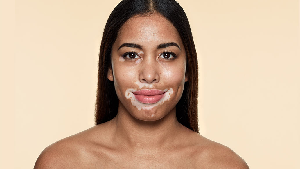 v_before-vitiligo.jpg